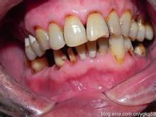 牙齿楔状缺损是什么意思？