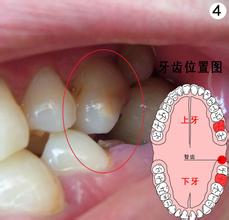 合肥怎么拔掉智齿？