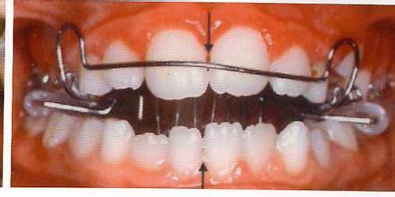 什么牙齿活动矫正器？
