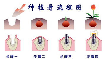 种植牙怎么护理