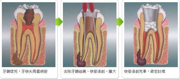 蛀了牙应如何预防？