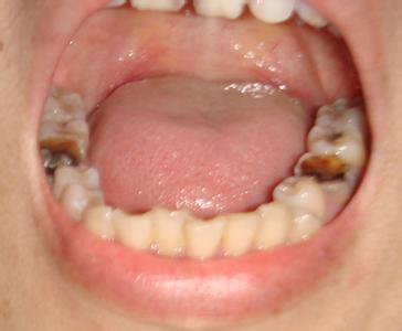 关于引起蛀了牙的原因有哪些？