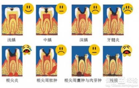 治疗龋坏要杀神经吗