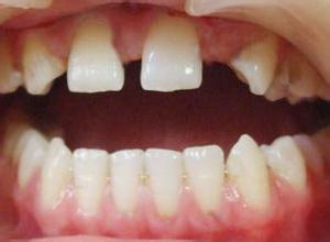 合肥牙列稀疏怎么治疗好呢?