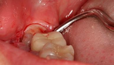 当拔牙操作不正确有哪些危害？