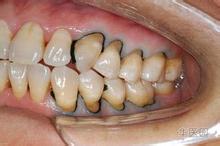 关于牙菌斑的预防？