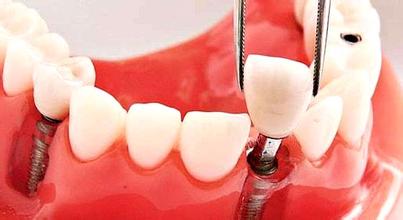 阐述种植牙是什么？