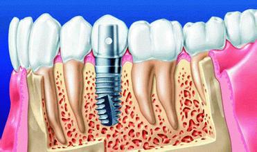 人工种植牙修复效果怎么样？