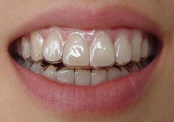 合肥儿童牙齿矫正需要多少钱？