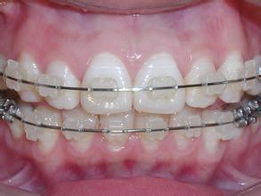 牙齿矫正的过程影响饮食吗？