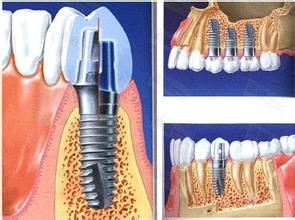 老人做种植牙应该注意的是什么？
