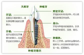 老人牙齿缺失能做种植牙吗？