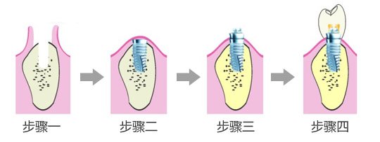 老人可不可以做种植牙呢?