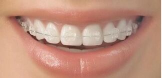 选择哪种矫正方法适合牙齿错位？