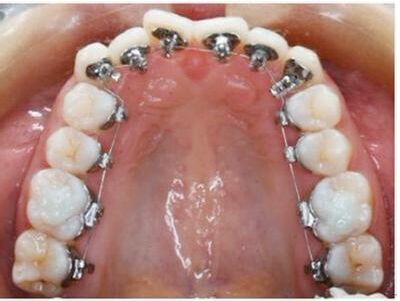 牙齿错位的常见症状可分为哪些？