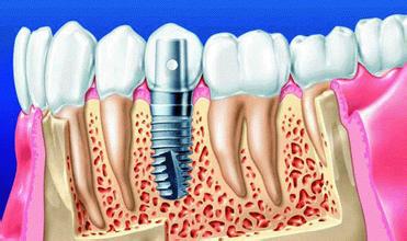 老人出现前牙缺失种植修复术？