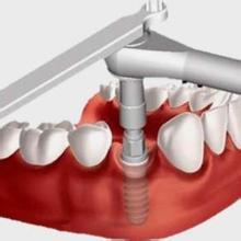 都想问的问题，什么是牙齿种植？