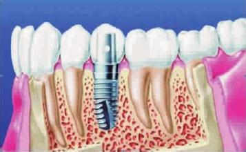 合肥种植牙安全吗？