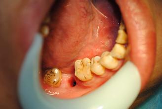 种植牙的适合人群有哪些?