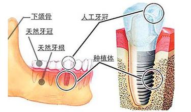 单个牙缺失怎么重拾微笑呢？