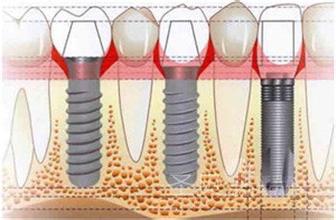 牙列缺失修复要用到多少钱？