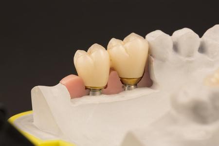 当牙龈萎缩能种植牙吗？