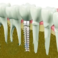 合肥种植牙的误区有哪些？