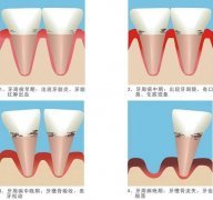 合肥牙齿疾病的治疗过程介绍