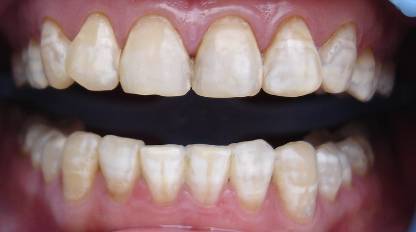 哪些原因会导致氟斑牙