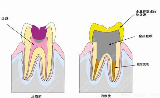 牙髓发炎