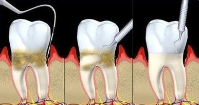 合肥牙周炎怎么治疗？