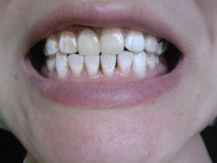 合肥氟斑色牙该怎么办?
