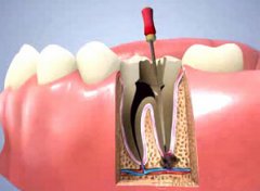 牙根尖周炎的表现和治疗方法?