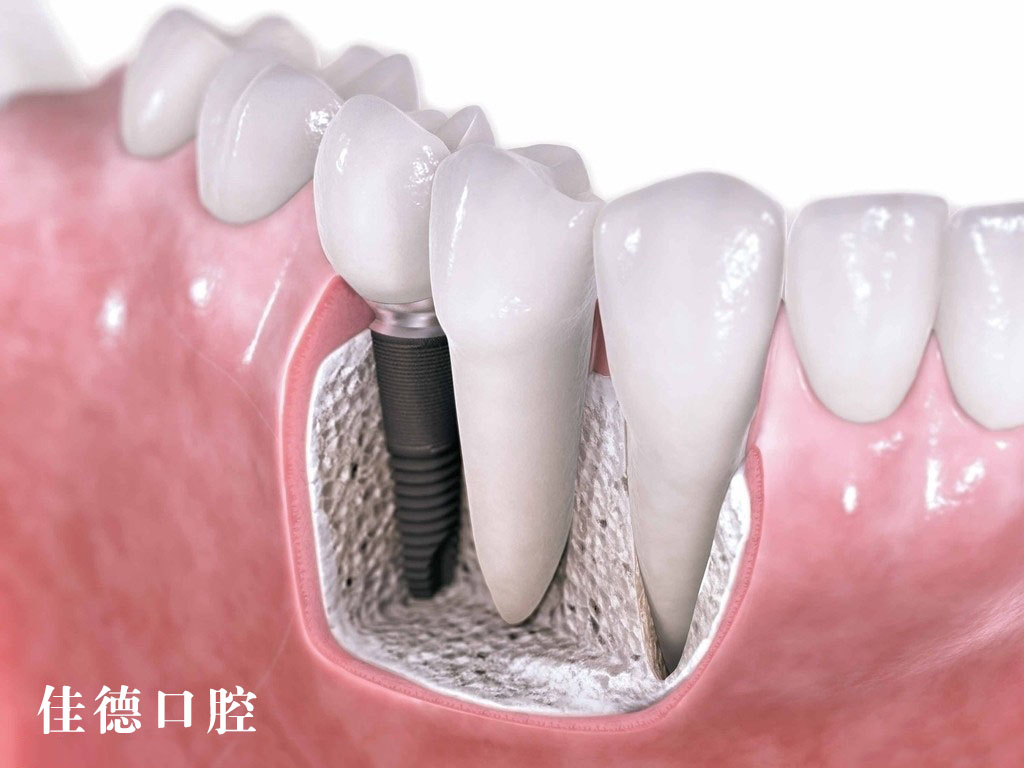 种植牙的过程
