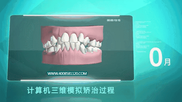 获取牙齿数据,将数据传递电脑进行矫治过程模拟,可观看矫正完成效果图
